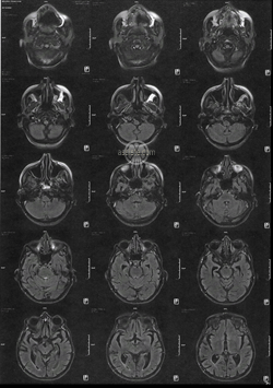 IRM - Imagerie par Résonnance Magnétique